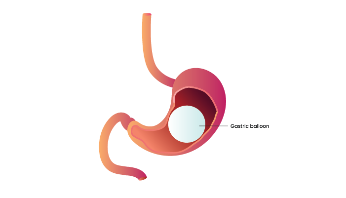 Illustration of Allurion Gastric Balloon for weight loss
