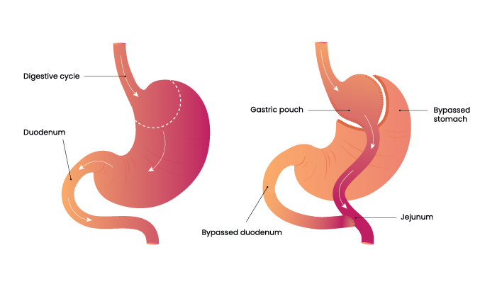 Illustration of gastric bypass for weight loss