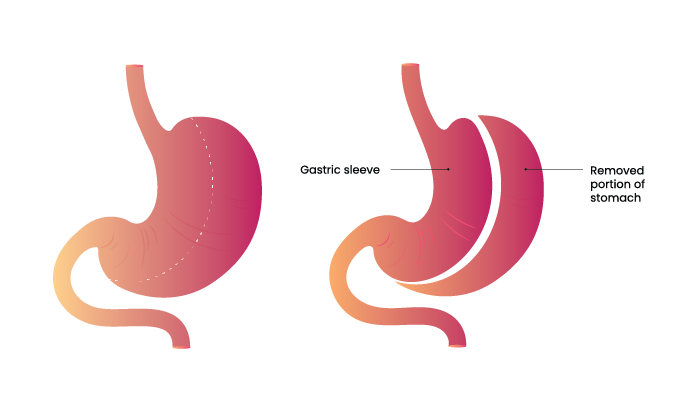 Illustration of gastric sleeve for weight loss